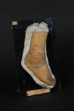 Éléphantiasis variqueux (Inv. 1922) de l'extrémité inférieure de la jambe. Pachydermie végétante (In [...]