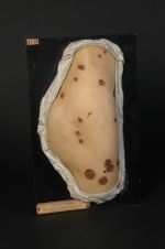 Syphilide pustulo-crustacée (Inv. 1889) de la hanche et de la cuisse