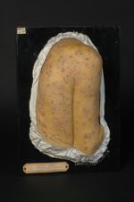 Plaques syphilitiques en cocarde (Inv. 1932) du dos et du bras. Femme âgée de 46 ans, marchande de p [...]