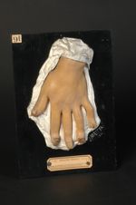 Onyxis syphilitique de la main gauche. Homme âgé de 24 ans, blanchisseur