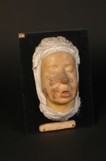 Lupus vulgaire ulcéro-croûteux de la face (Inv. 1922). Homme âgé de 16 ans, mouleur. Face et cou. Im [...]