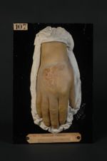 Leishmaniose cutanée (Inv. 1922). Bouton de Biskra ; ulcération du dos de la main. Homme âgé de 49 a [...]