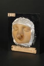 Syphilide tuberculo-ulcéreuse térébrante du nez (Inv. 1889). Femme âgée de 36 ans, couturière