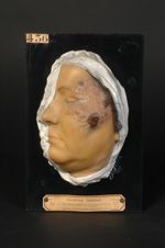 Lupus tuberculo-gommeux (Inv. 1889) ulcéré de la joue. Femme âgée de 36 ans, couturière