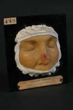 Epithéliome baso-cellulaire, type ulcus rodens (Inv. 1922), du nez. Femme âgée de 50 ans, concierge