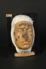 Syphilide pustulo-crustacée (Inv. 1889) de la face. Femme âgée de 27 ans, nourrice. Rupia syphilitiq [...]
