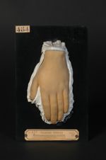 Naevus kératosique des mains et des pieds (Inv. 1922). Homme âgé de 22 ans, peintre (V. les n° 485,  [...]