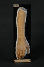 Eczéma chronique de l'avant-bras avec lésions des ongles, ayant simulé une lymphadénie cutanée