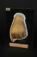 Chancre syphilitique de la main (moulage très décoloré, Inv. 1922)