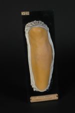 Lichen circonscrit (Inv. 1922) de la jambe. Lichen à grosses papules, plaque unique