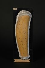 Macules pigmentées, consécutives à des syphilides de la jambe