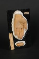 Xanthôme ; xanthélasma (V. les n° 543, main droite, et 544, face dorsale de la main gauche du même m [...]