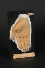 Xanthôme ; xanthélasma (V. les n° 542, gland et main, et 544, face dorsale de la main gauche du même [...]