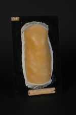Dermatose indéterminée (Inv. 1922) du liane, chez un bijoutier. Lichen pilaire circiné