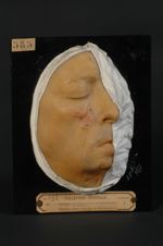 Epithéliome baso-cellulaire de la joue, sur cicatrice de brûlure (Inv. 1922)