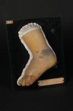 Lupus ulcéreux éléphantiasique du pied. Ichtyose secondaire, serpentine et cornée, localisée. Femme  [...]