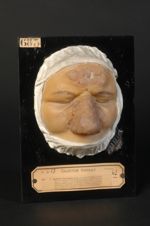 Syphilide tuberculeuse typique en groupe de la face et du nez, chez un boulanger alcoolique à un hau [...]