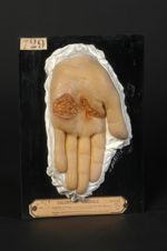 Syphilide ulcéreuse de la paume de la main (Inv. 1922). Homme âgé de 43 ans. Gommes syphilitiques ul [...]