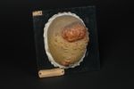 Molluscum contagiosum généralisé. Acné varioliforme, forme conglomérée, sur le cuir chevelu