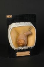 Tuberculose testiculaire, avec fongus (Inv. 1922). Fongus tuberculeux du testicule droit