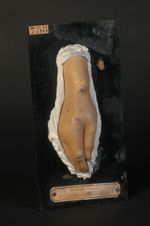 Gommes tuberculeuses de la main et du poignet. Forme lymphangitique (Inv. 1922). Homme âgé de 17 ans