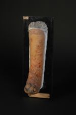 Lupus scléreux du pied et de la jambe gauche, avec éléphantiasis secondaire (Inv. 1922). Jambe et pi [...]