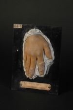 Tuberculose papillomateuse des doigts. Homme âgé de 40 ans