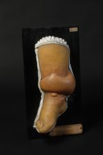 Bulles hémorragiques (Inv. 1922), dont une, très large, fait le tour de la jambe. Hémorragies cutané [...]