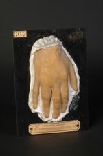 Cheirodactylite syphilitique tertiaire (V. les n° 868, main gauche, et 839, face palmaire de la main [...]