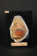 Epithéliome spino-cellulaire (Inv.1922) végétant, développé sur un lupus tuberculeux de la joue, qui [...]