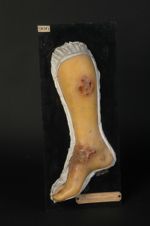 Syphilide gommeuse en nappe, de la jambe. (A l'aspect du moulage, on peut se demander s'il ne s'agit [...]