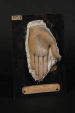Plaques syphilitiques (Inv. 1922) de la paume de la main. Homme âgé de 28 ans. Syphilide squameuse,  [...]