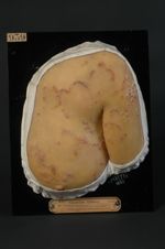 Dermatite herpétiforme de Duhring (Inv. 1922). Femme âgée de 43 ans