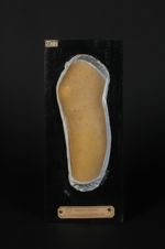 Syphilide papulo-squameuse pigmentée de la jambe, chez une blanchisseuse