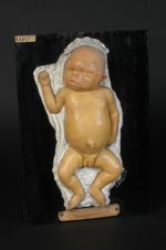 Fœtus syphilitique ; œdème congénital. Accouchement prématuré, au sixième mois de la grossesse