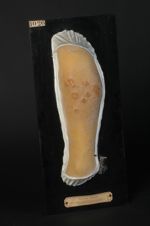 Chancres mous multiples, développés sur  un eczéma de la jambe. Homme âgé de 33 ans
