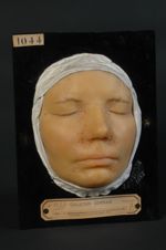 Adénomes sébacés symétriques de la face (type Balzer, lnv. 1922). Femme âgée de 26 ans