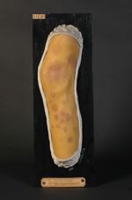 Favus de la cuisse et de la jambe en cours de traitement ; macules pigmentées à tendance cicatriciel [...]