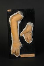 Gommes osseuses et sous-cutanées hérédo-syphilitiques de l'avant-bras et de la main ; syphilis héréd [...]