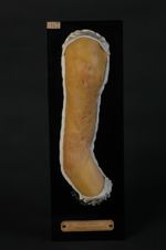 Chéloïde cicatricielle, sur syphilide ulcéreuse. Homme âgé de 40 ans, boulanger