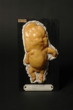 Œdème congénital chez un fœtus