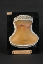 Acné chéloïdienne de la nuque (Inv. 1922) ; chéloïde acnéique de la nuque. Homme âgé de 48 ans, terr [...]
