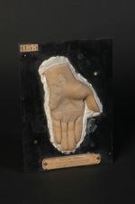Tuberculose cutanée verruqueuse de la main (Inv. 1922). Homme âgé de 65 ans, cocher. Tuberculose scl [...]