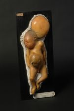 Méningo-encéphalocèle ; éventration, chez un fœtus