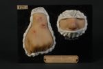 Leishmaniose cutanée (Inv. 1922) ; Bouton de Biskra à la période ulcéro-croûteuse, sur le nez et sur [...]