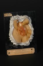 Ulcération vulvaire consécutive à un phlegmon gangreneux de la glande vulvo-vaginale gauche. Femme â [...]