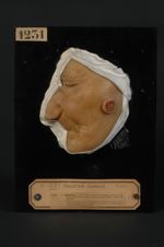 Épithéliome, spino-cellulaire à forme d'épithéliome corné (Inv. 1922) de la face. Femme âgée de 86 a [...]