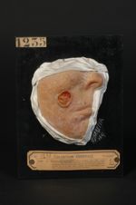 Épithéliome, probablement spino-cellulaire (Inv.1922), forme ulcéreuse, dans la cicatrice produite p [...]
