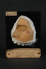 Épithéliome baso-cellulaire de la joue ; ulcération superficielle, dite en coup d'ongle (Inv. 1922), [...]