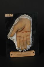 Prurigo de Hebra ; lésions secondaires des mains (Inv. 1922). Homme âgé de 66 ans, propriétaire. Lic [...]